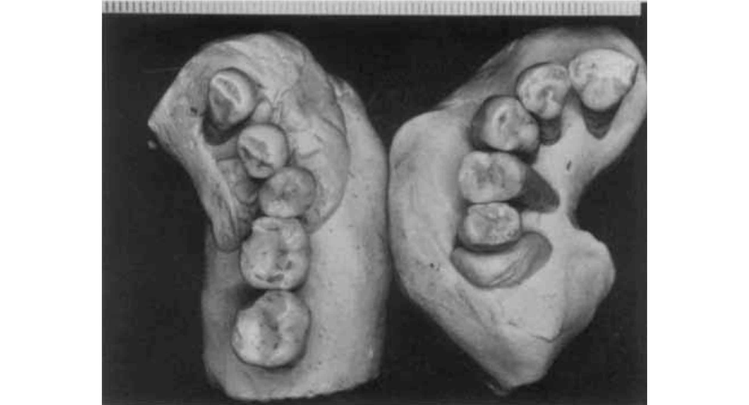 Part of an lower and upper set of teeth refitted with plasticine into occlusal shape