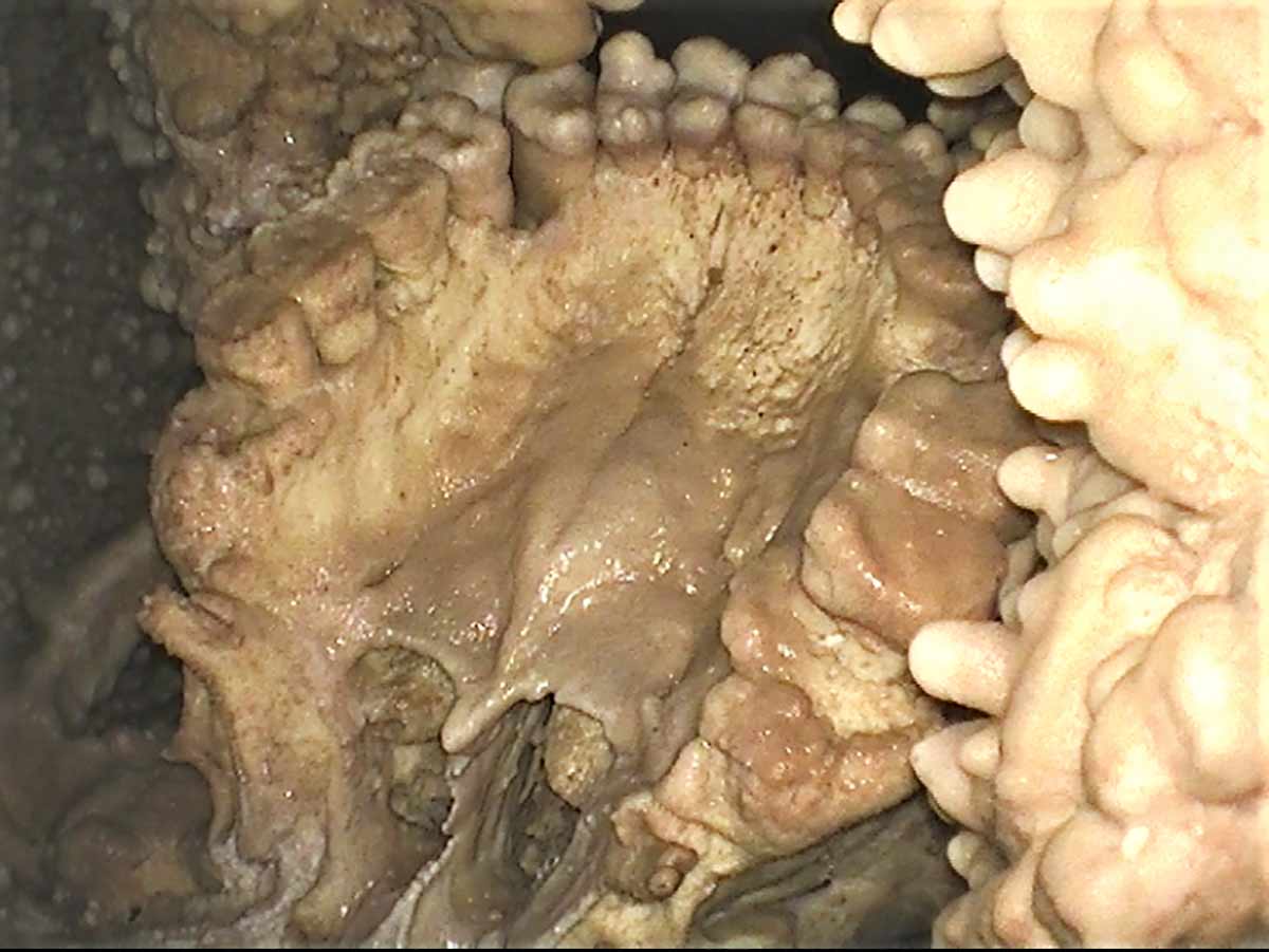 View of the palate and maxillary teeth of the Altamura Neanderthal, with surrounding encrustation of calcite