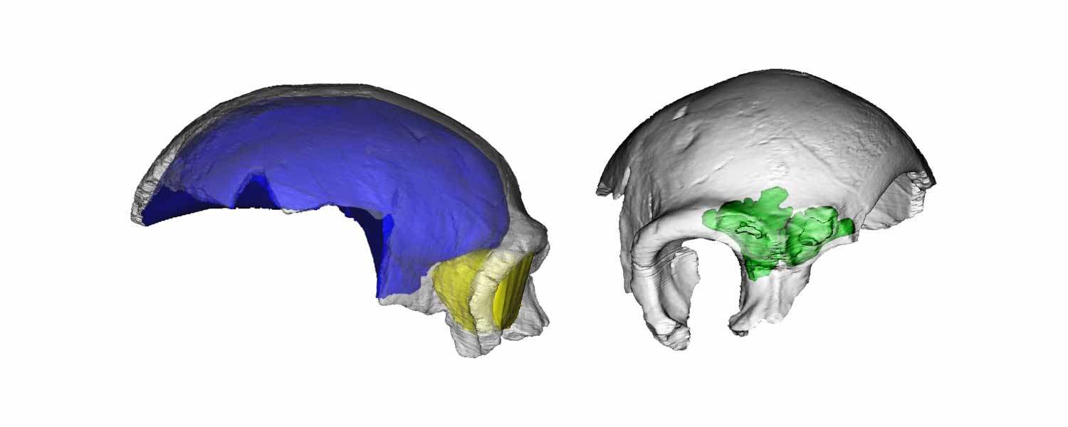 Left, lateral view of CT rendering, right frontal view